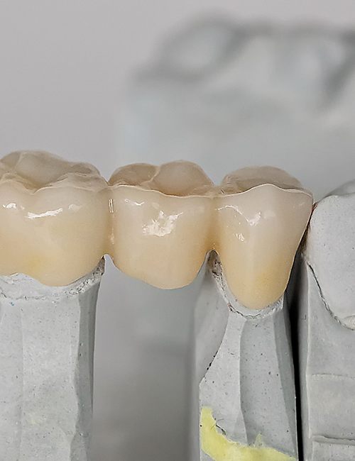 A dental bridge