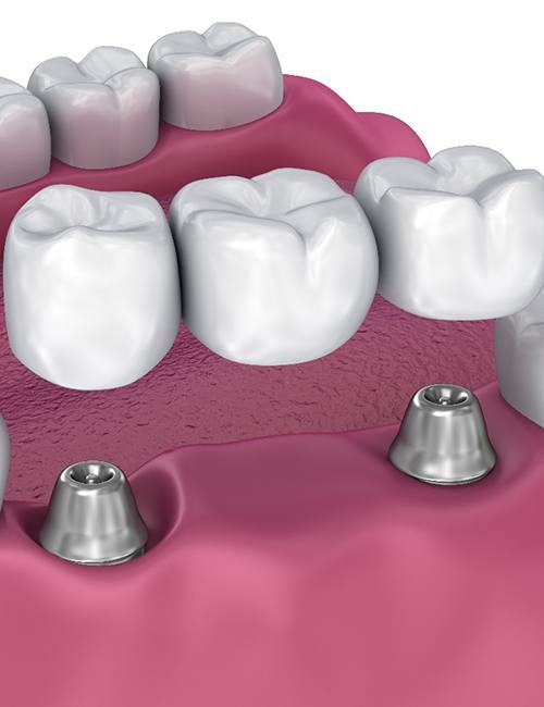 A digital model of an implant bridge