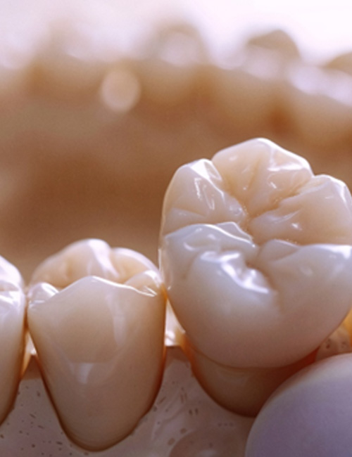 Dentist placing a dental crown 