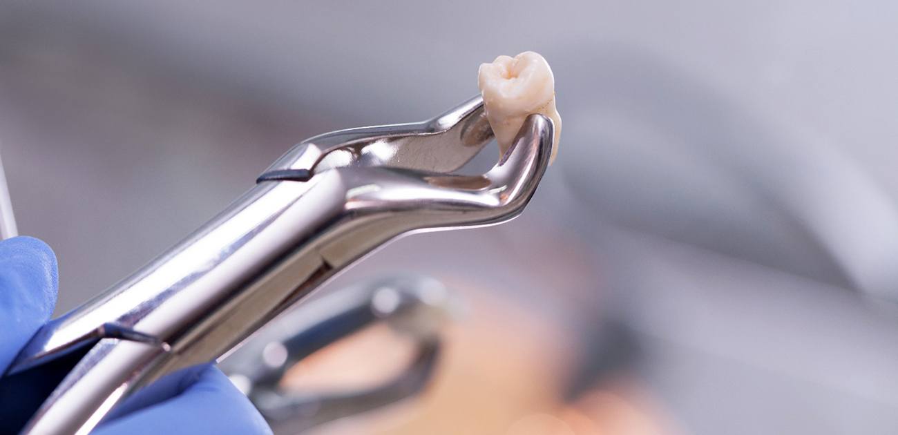 Extracted tooth held by forceps