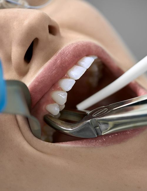 Closeup of woman undergoing tooth extraction