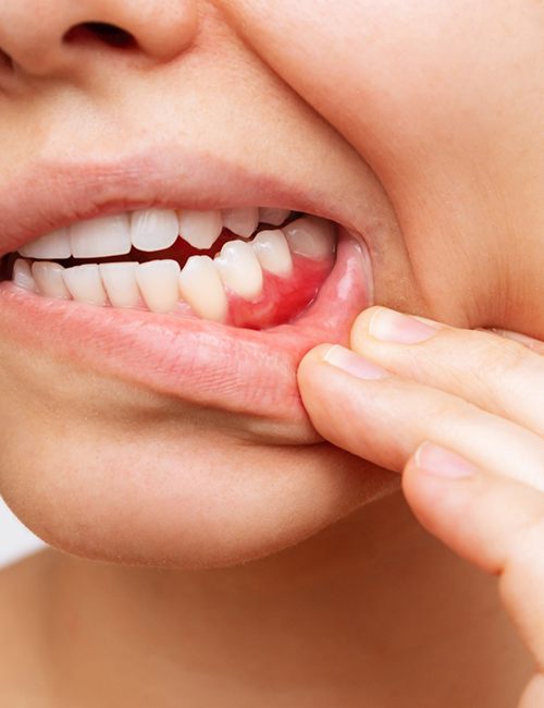 Closeup of patient showing red gums