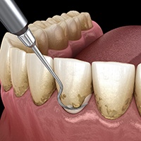 A CGI of a scaling and root planing procedure