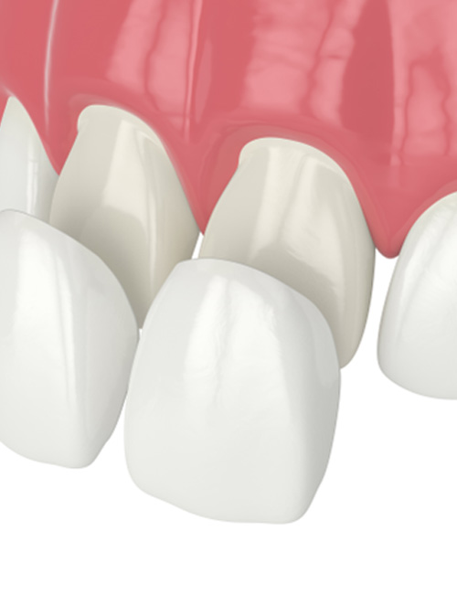 Digital image of veneers going on over front upper teeth 