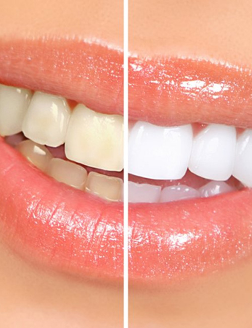 Before and after teeth whitening