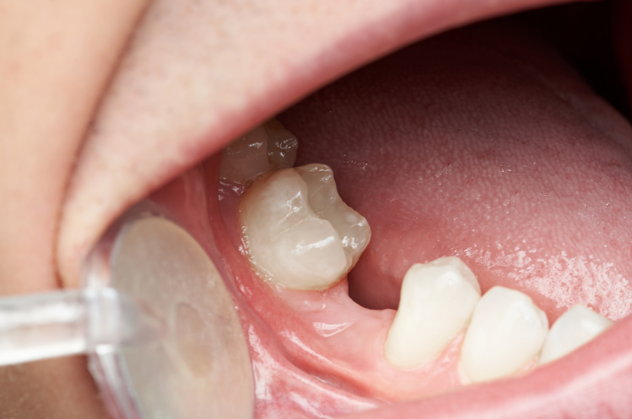 Close up of a missing molar