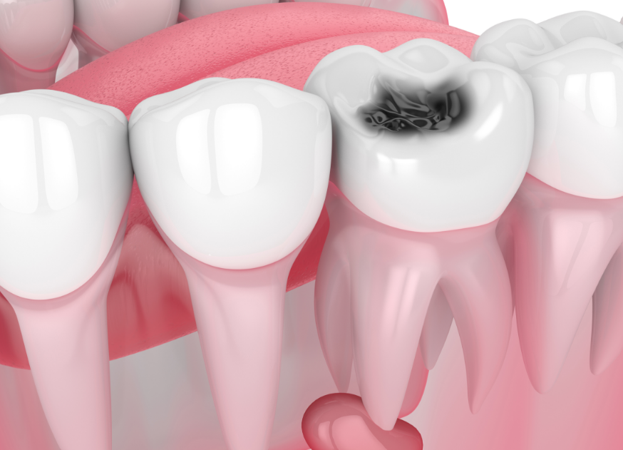3D image of a cavity on a middle tooth