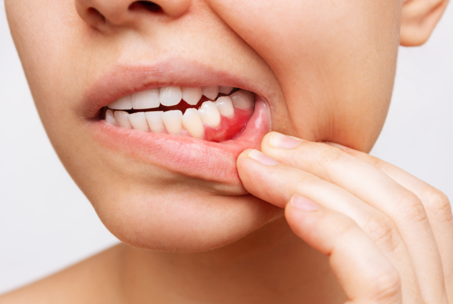 Close up of woman's mouth with reddened gums